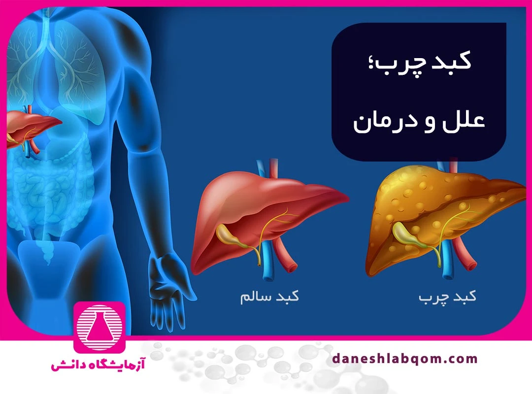 تفاوت کبد چرب گرید ۱، ۲ و ۳ : آزمایش و نکات آن